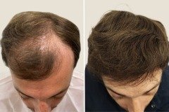 Before-after-1
