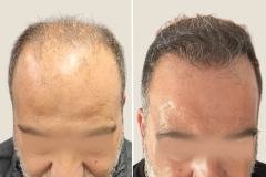 Before-after-5