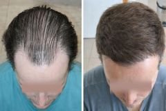 Before-after-9