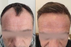 before-after-11
