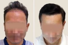 before-after-15