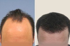 before-after-18