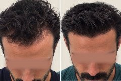 before-after-20