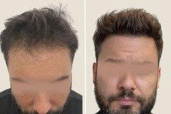 before-after-7