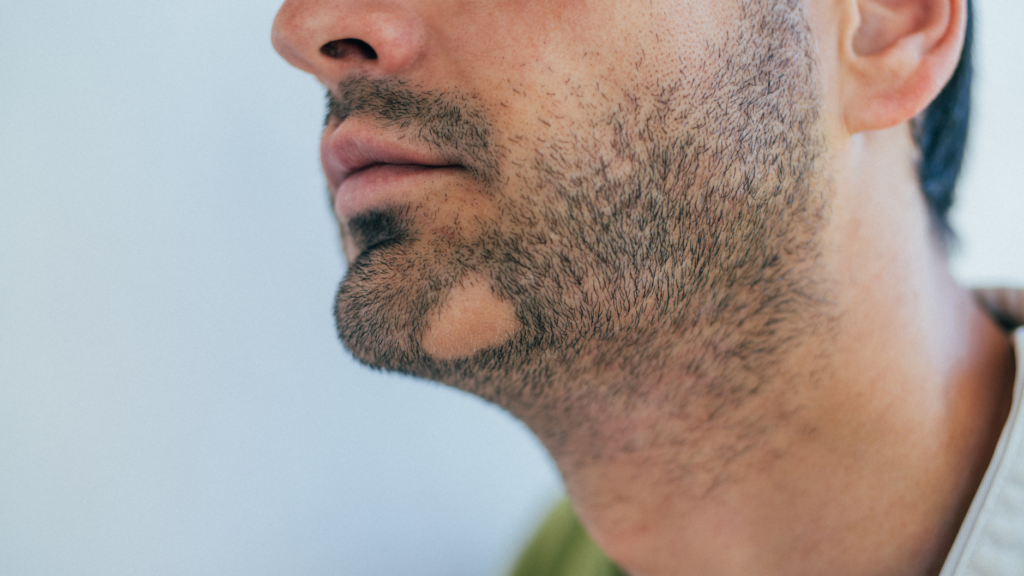 Specialized scientific team for beard transplantation at Clinique de Monsieur
