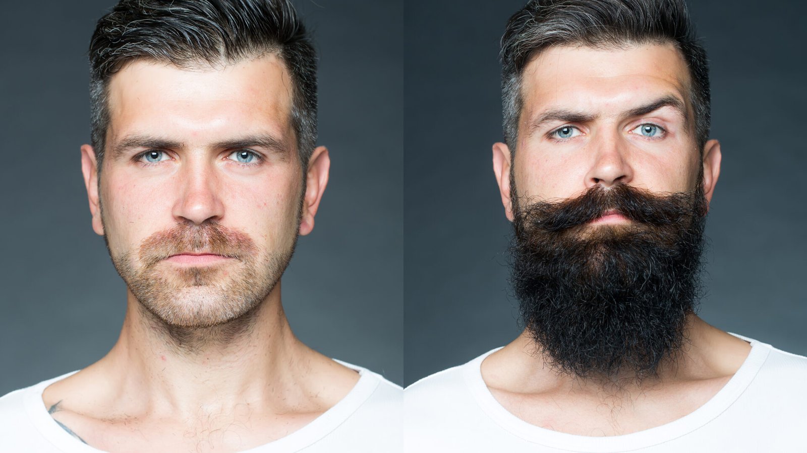 Result of beard transplantation with Direct FUE for thick and natural beards