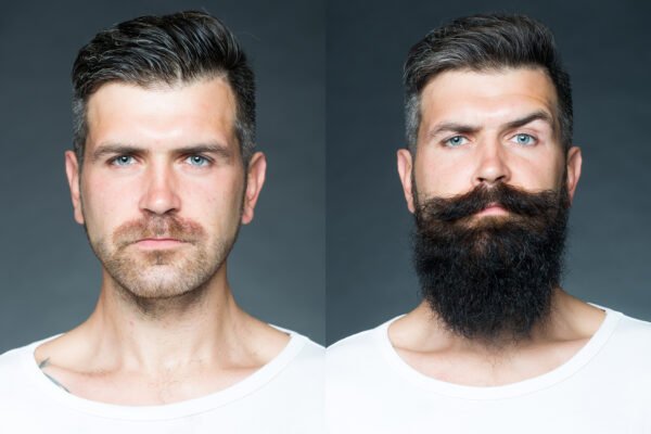 Result of beard transplantation with Direct FUE for thick and natural beards