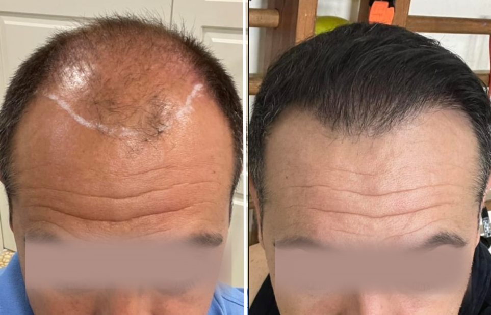 hair transplant, hair transplant step by step, Direct FUE hair transplant, hair restoration, hair transplant procedure, hair transplant recovery, hair transplant results, hair loss treatment, donor area hair transplant, Clinique de Monsieur