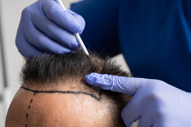 Doctor designs the hairline before a hair transplant for a man