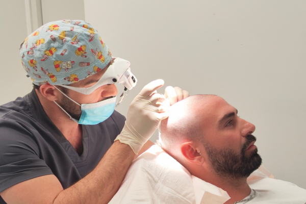 Direct FUE Hair Transplant Procedure at Clinique de Monsieur