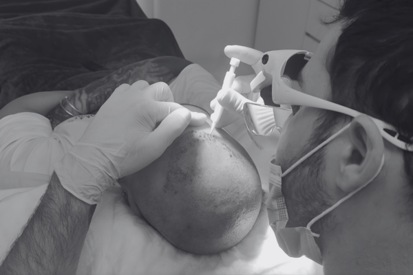 Medical extraction and implantation of grafts with precision during hair transplantation