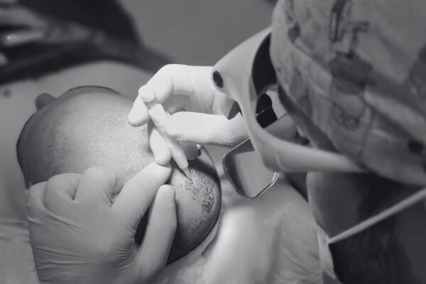 Doctor performing a hair transplant procedure on a patient’s scalp with precision instruments in a clinical setting.