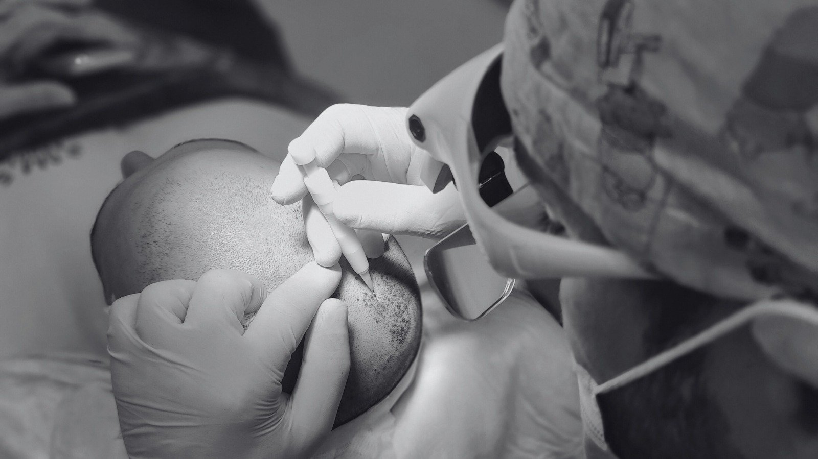 Doctor performing a hair transplant procedure on a patient’s scalp with precision instruments in a clinical setting.