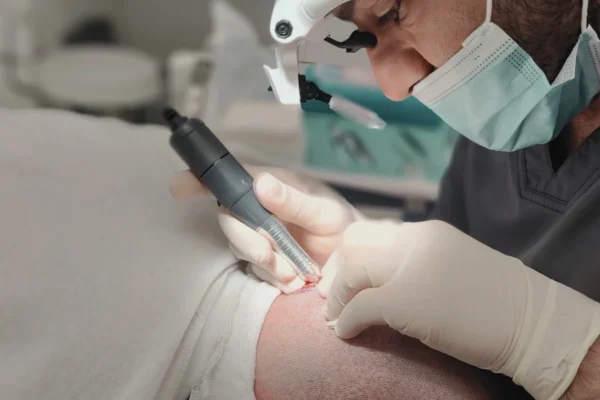 Γιατρός χρησιμοποιεί εξειδικευμένο εργαλείο σε μεταμόσχευση μαλλιών στους άνδρες