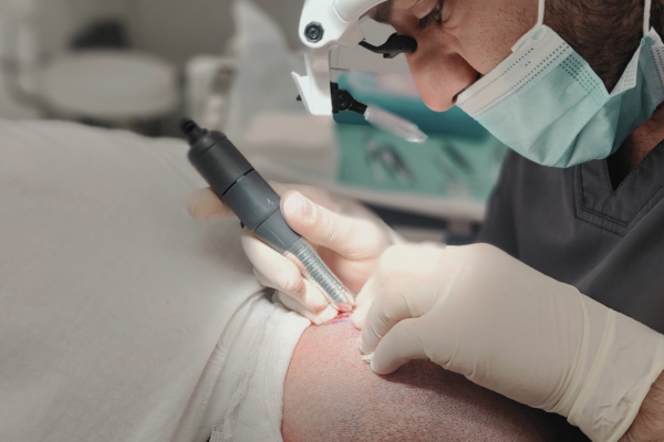 Close-up of a specialist performing a Direct FUE hair transplant with a precision implantation device on the frontal hairline.