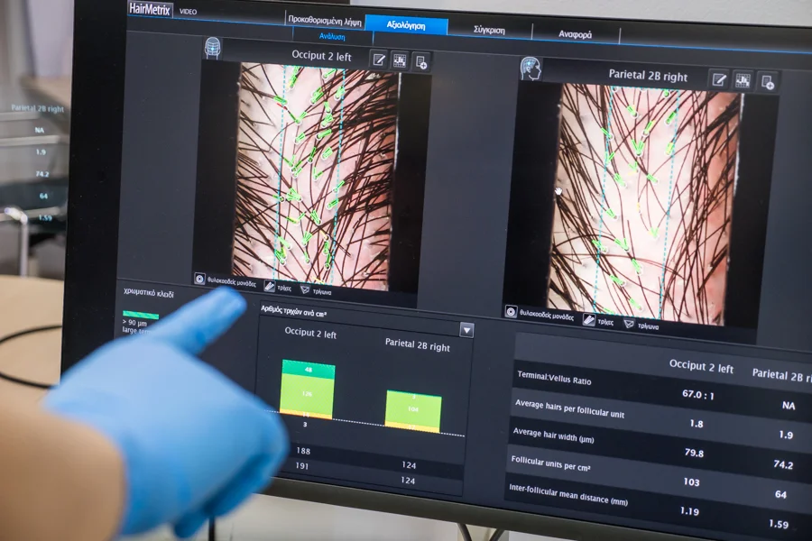 Ψηφιακή ανάλυση τριχωτού σε σωστή μεταμόσχευση μαλλιών πριν από τον ιατρικό σχεδιασμό