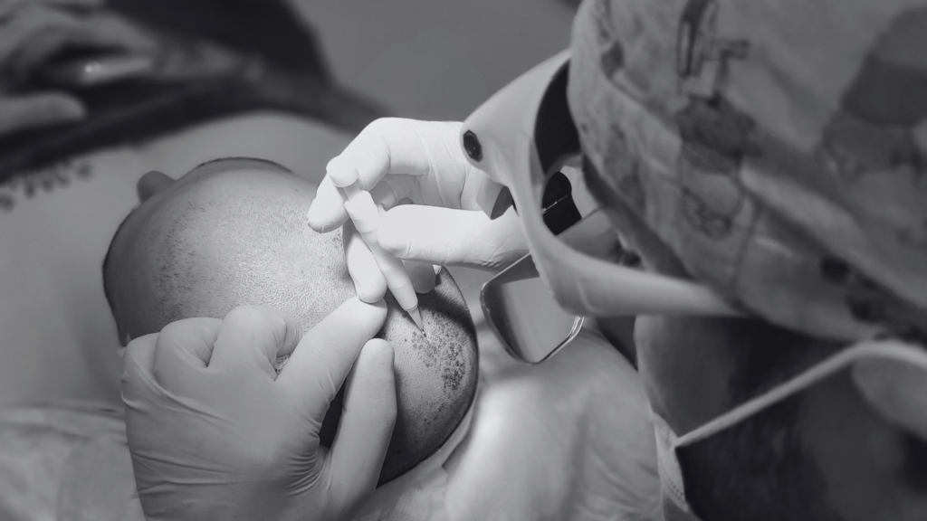 Placing grafts at the correct angle and natural direction for a natural result