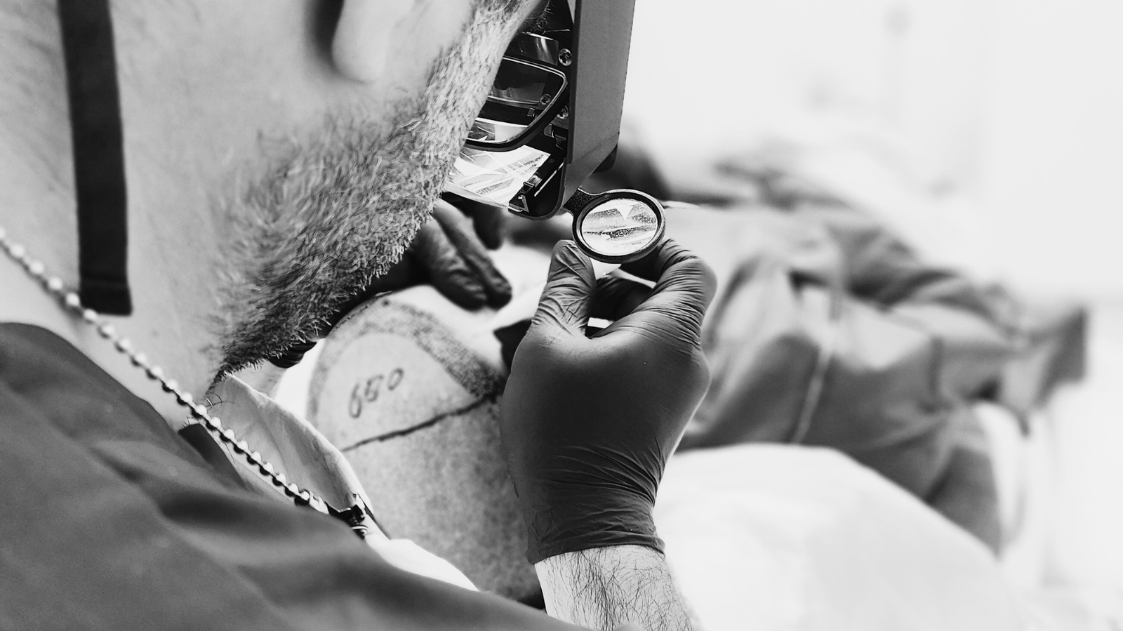 Εξαγωγή τριχοθυλακίων με τεχνική FUE στη δότρια περιοχή για Direct FUE