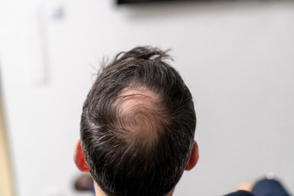 Crown thinning in male showing visible hair loss pattern