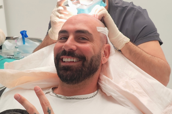 Patient smiling during a hair transplant procedure at the clinic