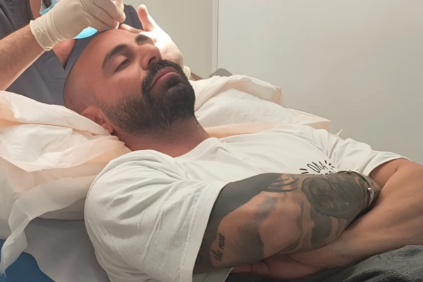 Αποθεραπεία μεταμόσχευσης μαλλιών αμέσως μετά τη διαδικασία