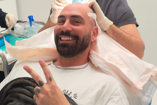 Graft survival hair transplant procedure using Direct FUE during implantation