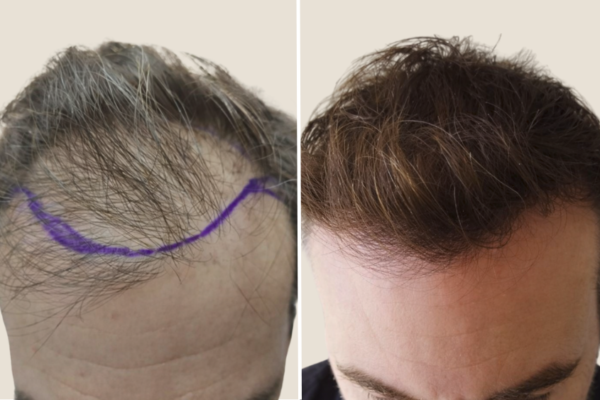 Before and after hair transplant showing improved hairline