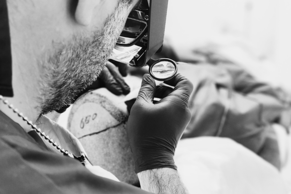 Hair graft inspection with magnifying lens during hair transplant