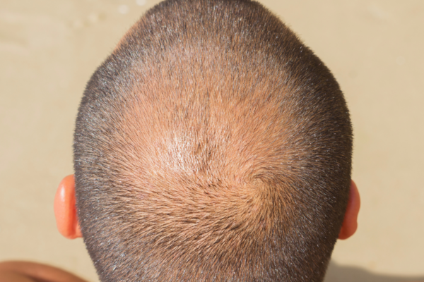 Short hair after hair transplant with visible thinning area