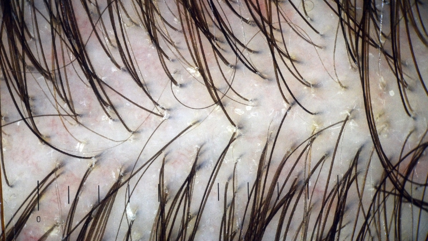 Scalp trichoscopy after hair transplant