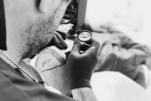 Έλεγχος μοσχευμάτων κατά τη διάρκεια μεταμόσχευσης μαλλιών