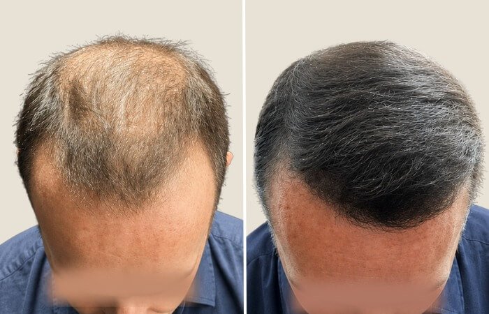 Before-after-24